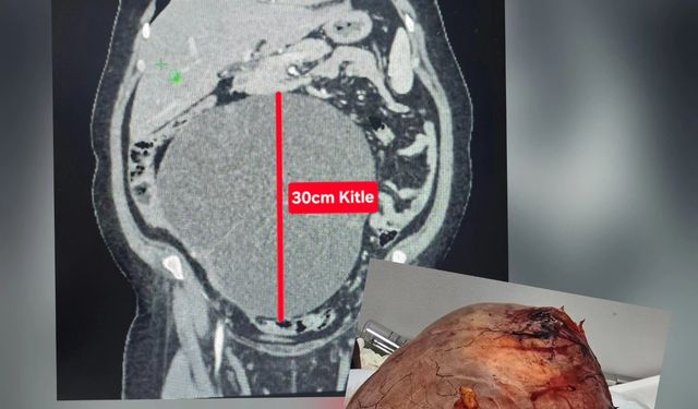 Uşak'ta karın ağrısı ve kabızlık şikayetiyle hastaneye giden vatandaşın karnından devasa kitle çıktı