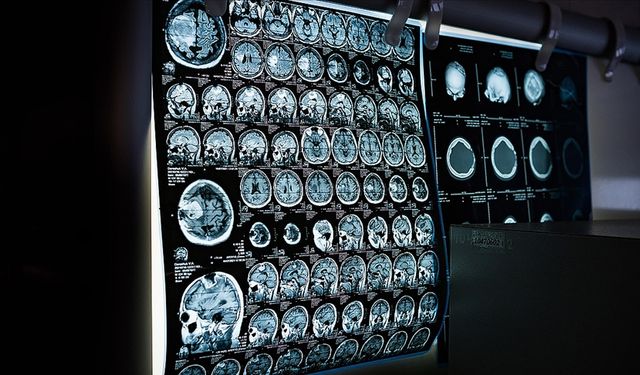 Nüksetme Şüphesi Olan Kanserle Mücadelede PET-CT Yöntemi